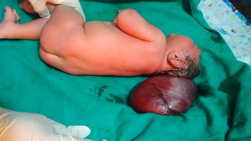 जाजरकोटमा अनौठो बच्चा जन्मियो
